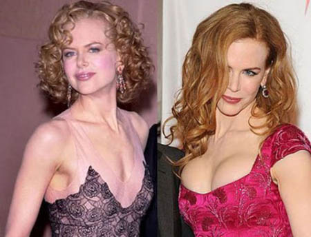 nicole_kidman_celebs_with_plastic_surgery_640_28